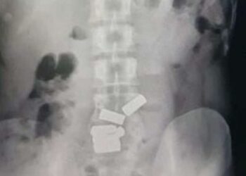 Gold Found In Stomach X-ray, Doctors Got Surprised Seeing It