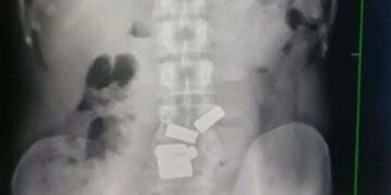 Gold Found In Stomach X-ray, Doctors Got Surprised Seeing It