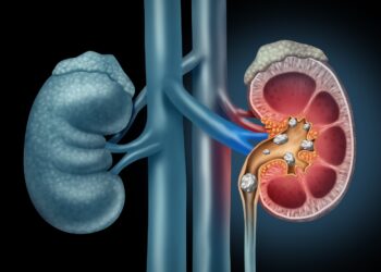 Why Do Kidney Stones Start Forming? Most People Are Unaware Of These Facts