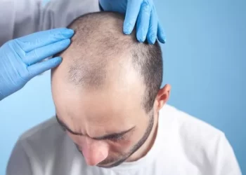 Before Considering A Hair Transplant, Here Are Five Things To Consider