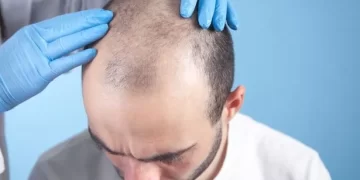 Before Considering A Hair Transplant, Here Are Five Things To Consider