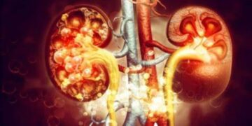 Natural Remedies To Reduce Uric Acid Levels – Vegetarian Alternatives