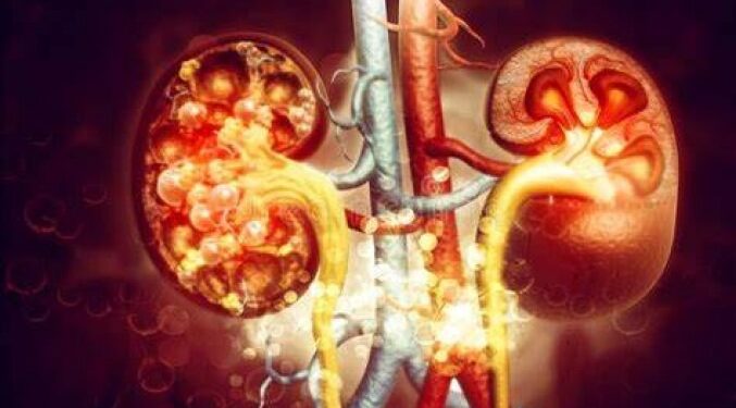 Natural Remedies To Reduce Uric Acid Levels – Vegetarian Alternatives