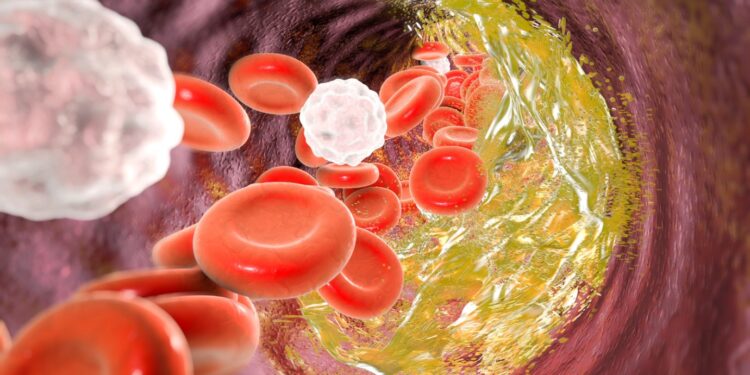 A promising method for reducing LDL cholesterol is gene editing.