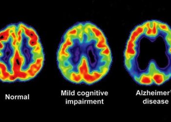 Alzheimer’s disease may be transmitted, Under very rare conditions