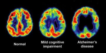 Alzheimer’s disease may be transmitted, Under very rare conditions