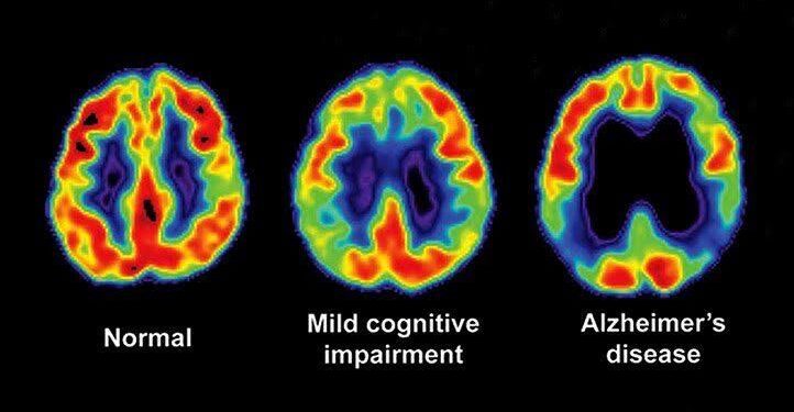 Alzheimer’s disease may be transmitted, Under very rare conditions
