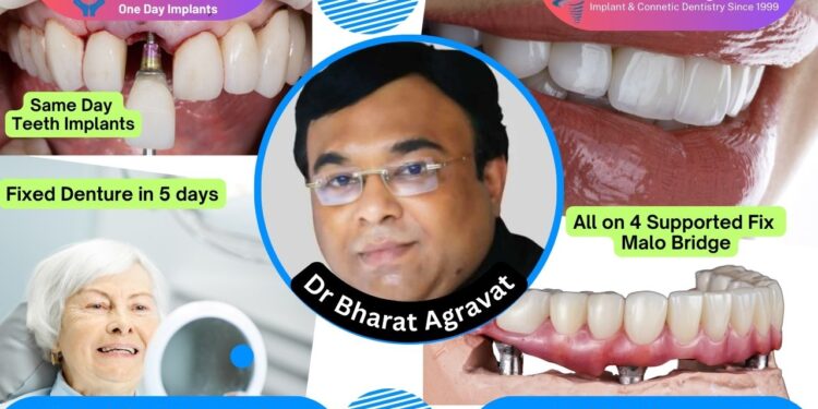Best Dentist for Full Mouth Dental Implants Clinic in Ahmedabad: Dr. Bharat Agravat, the  top Implantologist.
